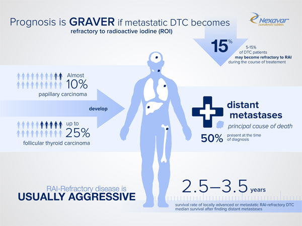 Nexevar Infographics